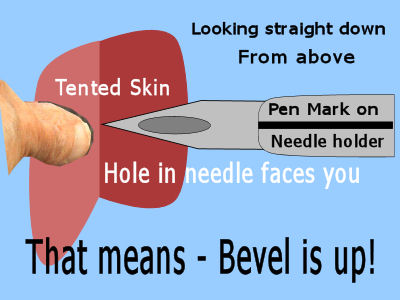 Placing bevel ready to slide under skin