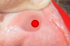 Blood wells up